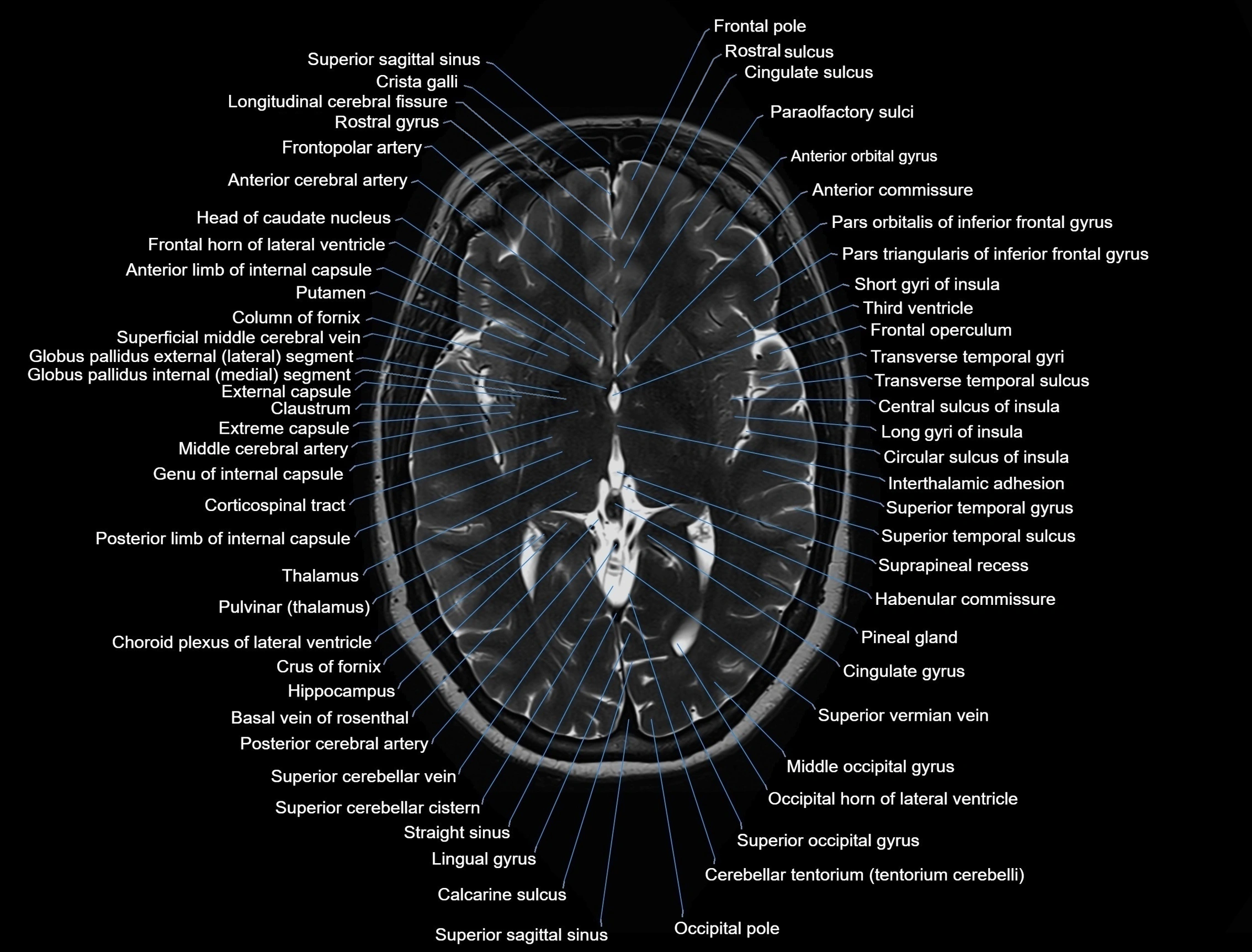 MRI Brain axial cross sectional radiology anatomy 3T image  -img-00001-00028.webp